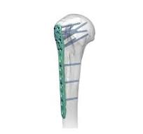 Proximal Humeral Locking Plate Ⅱ,Medical Device ...