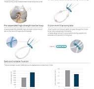 CFLoop Adjustable Button,Medical Device Manufacturers ...
