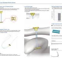 AC CFLoop Adjustable Button System,Medical Device ...