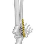 Ankle Fibula Locking Plate System | HNM Medical