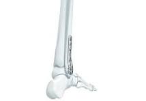 LCP™ Distal Fibula Plate System (2.7/3.5 mm) | Products ...