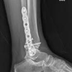 Pangea™ Distal Lateral Fibula Plate - Implants - Orthobullets