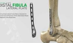 Zimed | Locking Distal Lateral Fibula Plate