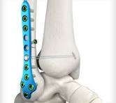 Lateral Fibula Plates - Unite Foot and Ankle