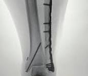 Pangea™ Distal Lateral Fibula Plate - Implants - Orthobullets