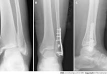 Locking plates for distal fibula fractures in young and ...