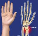 Distal Radius Fracture Repair with Volar Plate San Luis ...