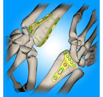 Locking Distal Radius System 2.4