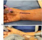 Volar Locking Plate Fixation of Distal Radius Fractures: A ...