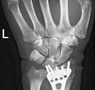 Volar locking plate | Radiology Reference Article ...