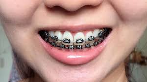 Black And Pink Braces Colors Image Result Teeth Braces Black Braces Teeth Cute Braces