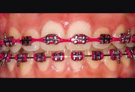 Black And Pink Braces Colors Pink Braces Power Chain Pink Braces Teeth Braces Braces Colors