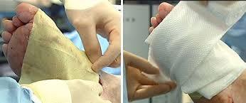 Xeroform Petrolatum Dressing Instructions To Heal Burns With Xeroform Faster The Burn Or Wound Heals Without Scar Proper Hand Washing Petrolatum Medical Glove
