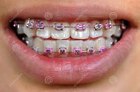Black And Pink Braces Colors Hot Pink Braces Teeth Braces Ideas Braces Colors Pink Braces Teeth Braces