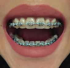 Black And Pink Braces Colors Dark Colors Such As Black Dark Purple And Light Blue Make Your Teeth Look More Braces Colors Cute Braces Braces Teeth Colors