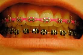 Black And Pink Braces Colors Braces D Teeth Braces Pink Braces Braces Colors