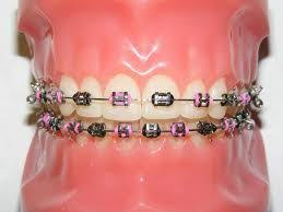 Black And Pink Braces Colors Black And Pink Cute Pink Braces Braces Braces Colors