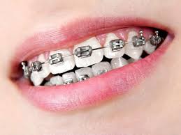 Black And Pink Braces Colors Silver Black Braces Teeth Braces Ideas Braces Colors Teeth Braces Metal Braces
