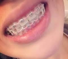 Black And Pink Braces Colors Braces Braces Colors Brace Face Braces Teeth Colors
