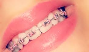 Black And Pink Braces Colors Make Your Colors Match Pinkonpink Braces Oralcare Trendybraces Colors Pink Braces Cute Braces Colors Braces Colors