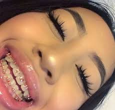 Black And Pink Braces Colors Follow Me For More Amour Naturals Braces Colors Cute Braces Pink Braces