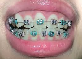 Black And Pink Braces Colors How To Make An Interesting Art Piece Using Tree Branches Ehow Braces Colors Braces Teeth Colors Dental Braces Colors