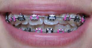 Black And Pink Braces Colors Pinkblackbraces Braces Colors Dental Braces Colors Cute Braces Colors