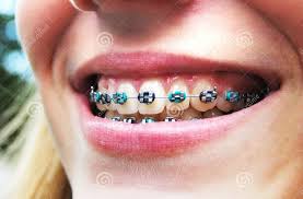 Black And Pink Braces Colors Orthodontic Braces Colors Teeth Braces Ideas Braces Colors Orthodontics Braces Orthodontics