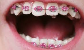 Black And Pink Braces Colors Pink Braces Braces Colors Pink Braces Teeth Braces