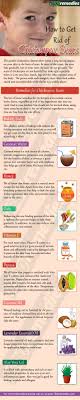 Pin On Home Remedies