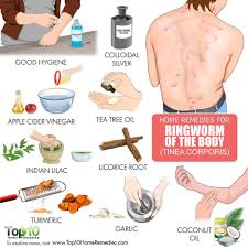 How To Get Rid Of Ringworm Of The Body Ringworm Remedies Home Remedies For Ringworm Get Rid Of Ringworm