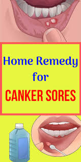 Home Remedy For Canker Sores Canker Sore Remedy Canker Sore Tongue Sores