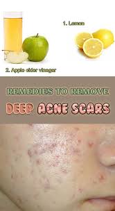 Pin On Back Acne Tips