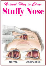 Home Remedies For Stuffy Nose Sinus Remedies Allergy Remedies Stuffy Nose Remedy