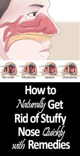 12 Diy Home Remedies For Stuffy Nose Life And Shape Home Health Remedies Health Heal Stuffy Nose Remedy