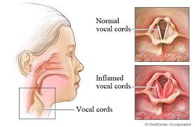 Inflamed Vocal Cords In Laryngitis Home Remedies For Laryngitis Home Health Remedies Laryngitis Remedies