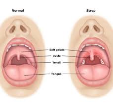 Home Remedies For Strep Throat Home Remedies For Strep Strep Throat Home Remedies Home Health Remedies