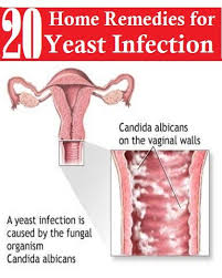 Home Remedies For Yeast Infections 20 Natural Treatments Yeast Infection Home Remedy Yeast Infection Treatment Treat Yeast Infection