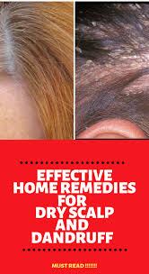 Home Remedies For Dry Scalp And Dandruff Home Remedies Dry Scalp Remedy Home Remedies For Pimples