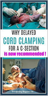 Delayed Cord Clamping During C Section Birth Great Benefits With Only 30 Second Delay Delayed Cord Clamping Cord Clamping Baby Sleep Problems