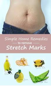 10 Natural Home Remedies For Stretch Marks Stretch Mark Remedies Stretch Marks Natural Skin Care