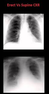 Basics Of Reading Chest Xray Complete Guide To Cxr Beginners Medicforyou In 2020 Radiology Imaging X Ray Radiology Technologist
