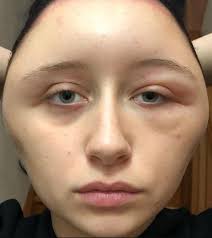 Teenager S Head Doubles In Size After She Suffers Reaction To A Hair Dye
