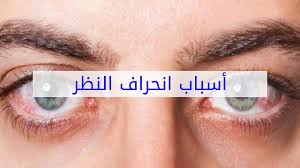 أسباب انحراف النظر Youtube