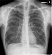 Normal Chest X Ray With Diaphragmatic Slips When The Lungs Are Hyperexpanded It Is Important Not To Confuse Blunting Of A Costophre Radiology X Ray Vision Eye