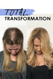 New Hope For Thinning Hair Clients Hair Thinning On Top Why Hair Loss Normal Hair Loss