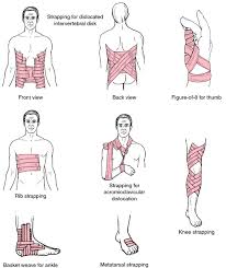 Strapping Definition Of Strapping By Medical Dictionary Medical Dictionary Definitions Medical