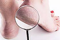 Como Tirar Rachaduras Dos Pes Em Casa Dermatologista Ensina O Jeito Certo Pes Rachados Rachaduras Nos Pes Rachadura