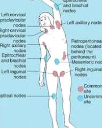 Definition Of Hodgkins Lymphoma In The Medical Dictionary By The Free Dictionary Lymphmassage Lymph Massage In 2020 Lymphatic System Lymph Massage Medical Knowledge