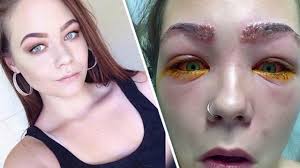 16 Yr Old Teenager Almost Blinded After Hair Dye Fail Allergic Reaction Hair Fails Dyed Hair Hair